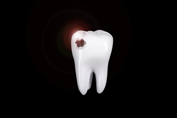 How A Laser Dentist Can Treat Cavities